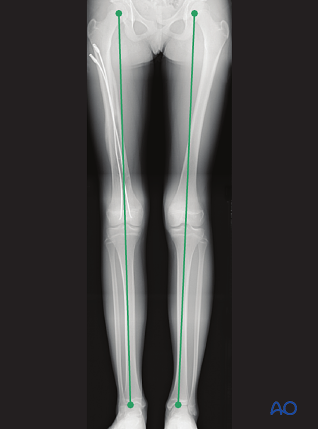 Leg length measured in a long-leg x-ray from femoral head to ankle joint