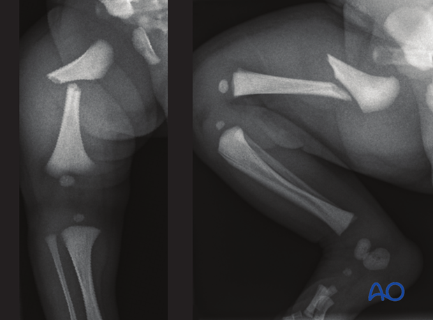 X-rays of a femoral shaft fracture