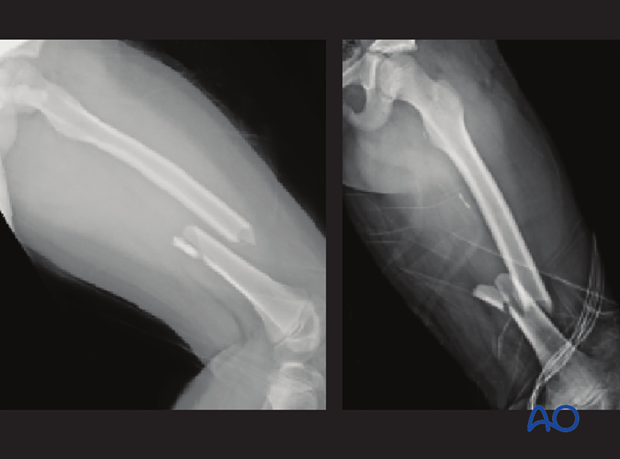 AP and lateral view x-rays of a multifragmentary femoral shaft fracture