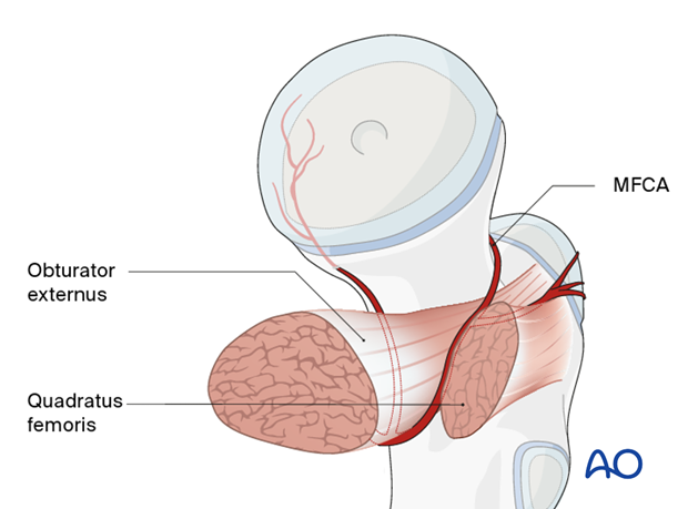 Main branch of the medial femoral circumflex artery (MFCA)