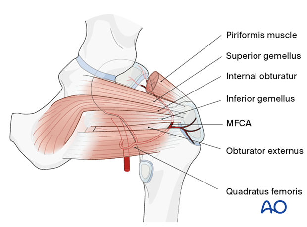 Main branch of the medial femoral circumflex artery (MFCA)
