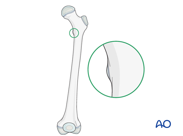 Lesser trochanter profile of uninjured femur