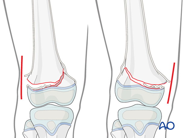 Open reduction of Salter-Harris II fractures