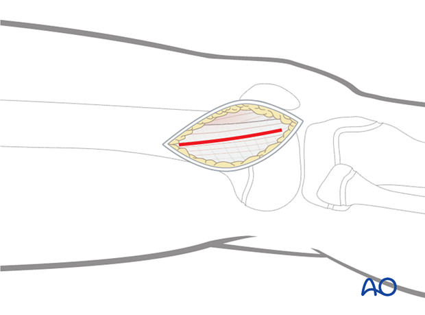 Division of the iliotibial band