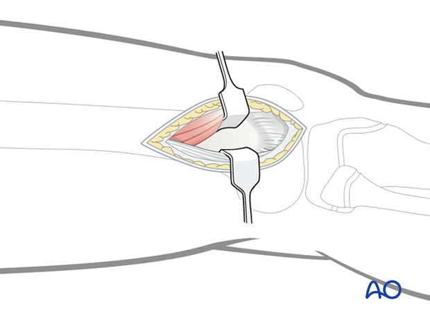 Incision of the fascia