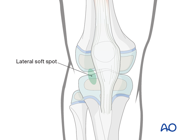Lateral soft spot