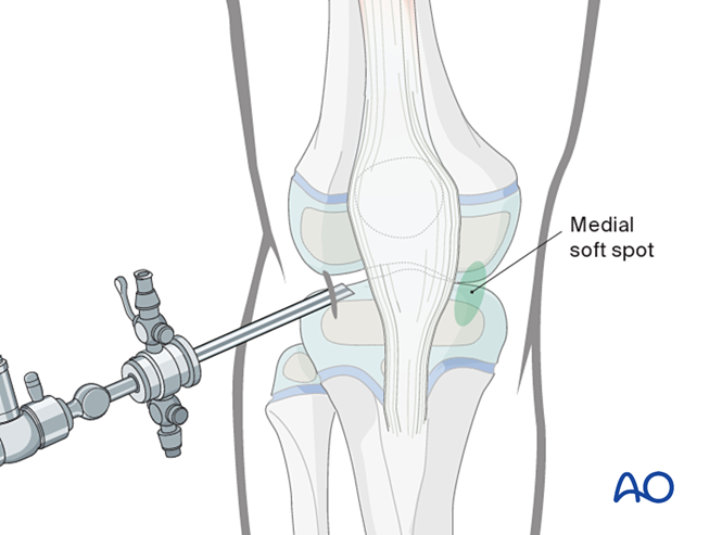 Arthroscopic approach to the pediatric knee