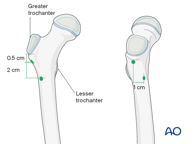 ESIN entry points for antegrade nailing of the femur