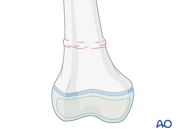 Torus/buckle fracture of the distal femur