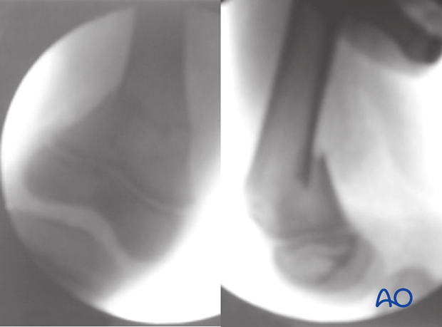 X-ray of a simple, complete metaphyseal fracture of the distal femur