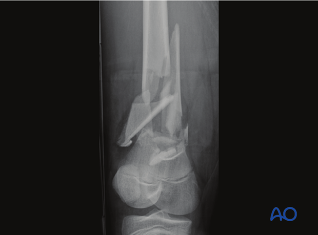 X-ray of a multifragmentary, complete metaphyseal fracture of the distal femur