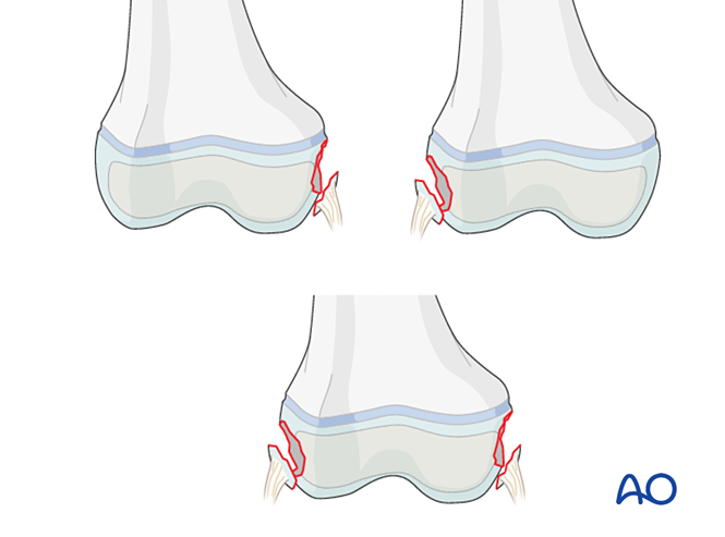 Metaphyseal, avulsion
