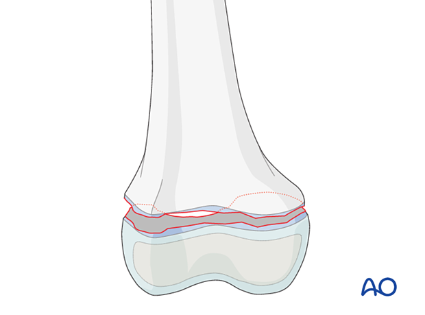 Epiphysiolysis (Salter-Harris I) of the distal femur