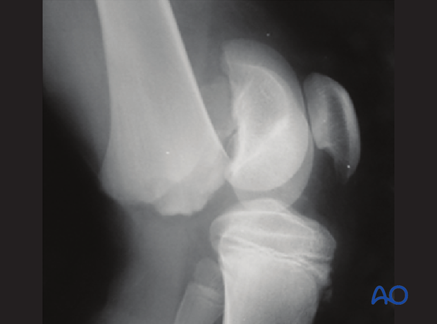 X-ray of an epiphysiolysis (Salter-Harris I) of the distal femur