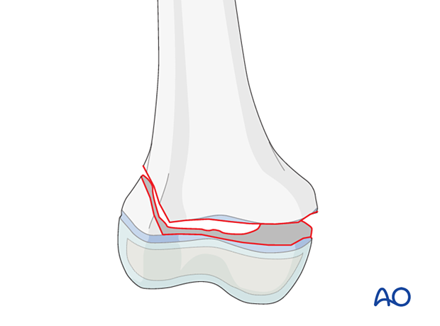 Simple epiphysiolysis with metaphyseal wedge (Salter-Harris II) of the distal femur