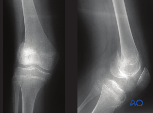 X-ray of a simple epi-/metaphyseal fracture (Salter-Harris IV) of the distal femur