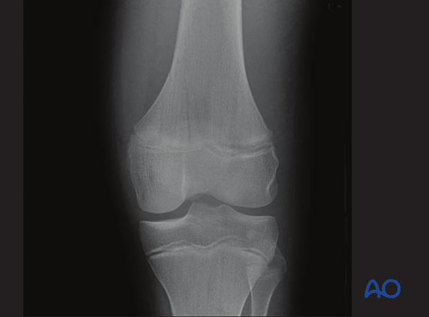 X-ray of a simple epiphysiolysis with metaphyseal wedge (Salter-Harris II) of the distal femur