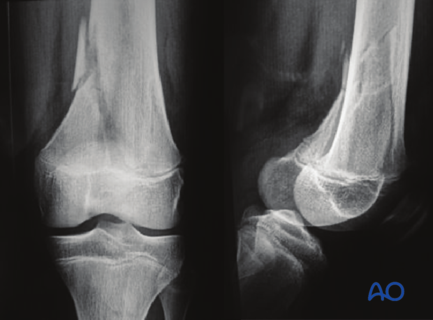 X-ray of a multifragmentary epiphysiolysis with metaphyseal wedge (Salter-Harris II) of the distal femur