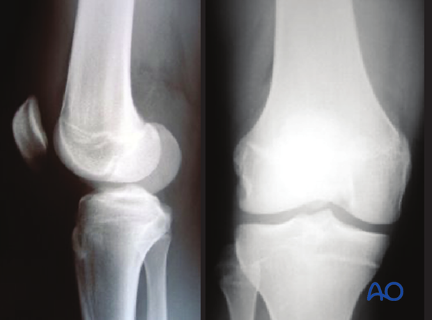 X-ray of a simple epiphyseal fracture (Salter-Harris III) of the distal femur