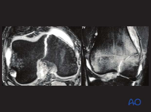 MRI axial and coronal views showing Salter-Harris III epiphyseal fracture