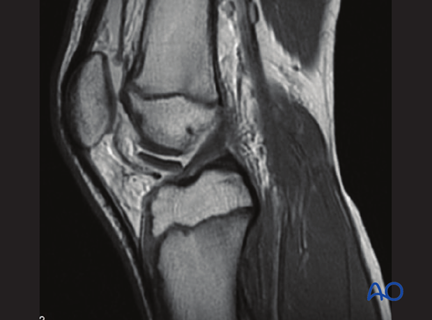 MRI of an intraarticular flake fracture of the distal femur