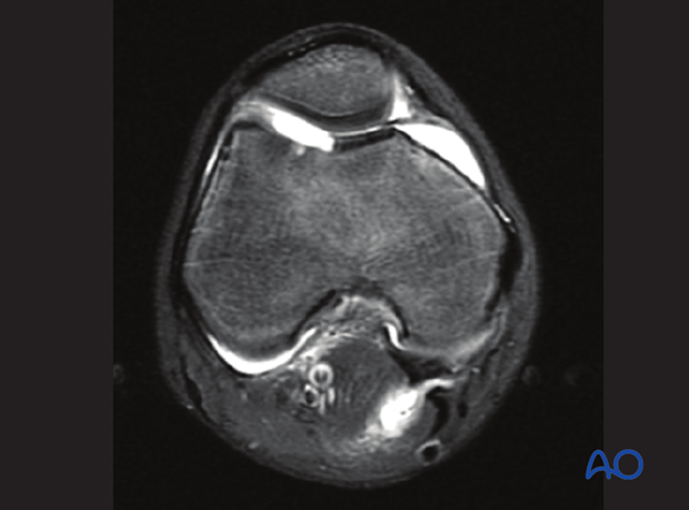 MRI of an intraarticular flake fracture of the distal femur
