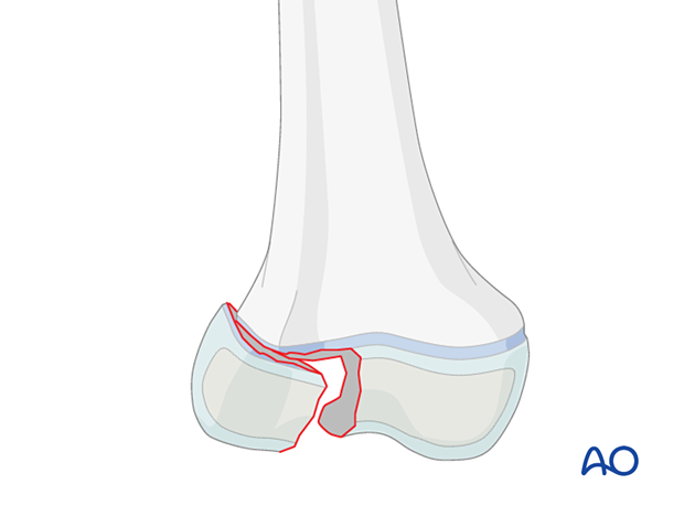 Simple epiphyseal fracture (Salter-Harris III) of the distal femur