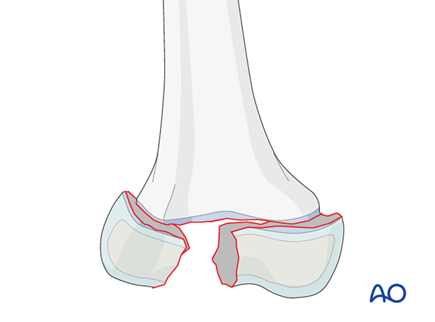 Multifragmentary epiphyseal fracture (Salter-Harris III) of the distal femur