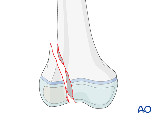 Simple epi-/metaphyseal fracture (Salter-Harris IV) of the distal femur