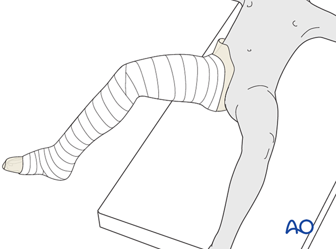 Long leg cast