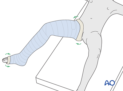 Long leg cast