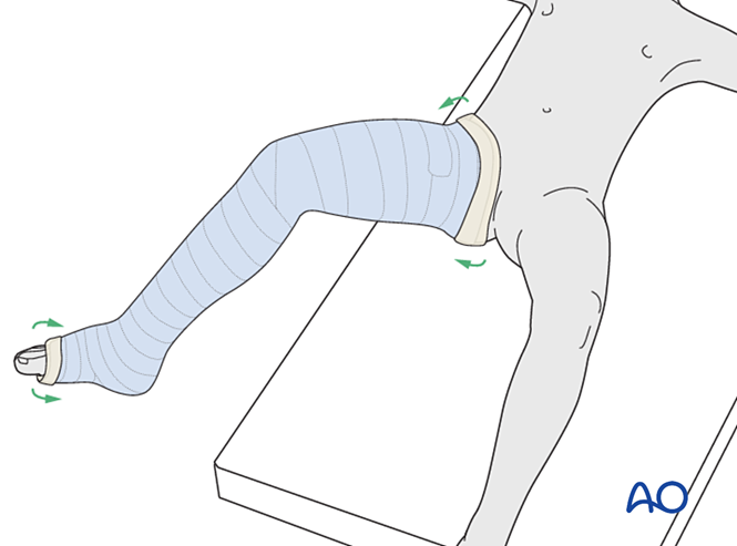 Term Leg Cast Long leg cast