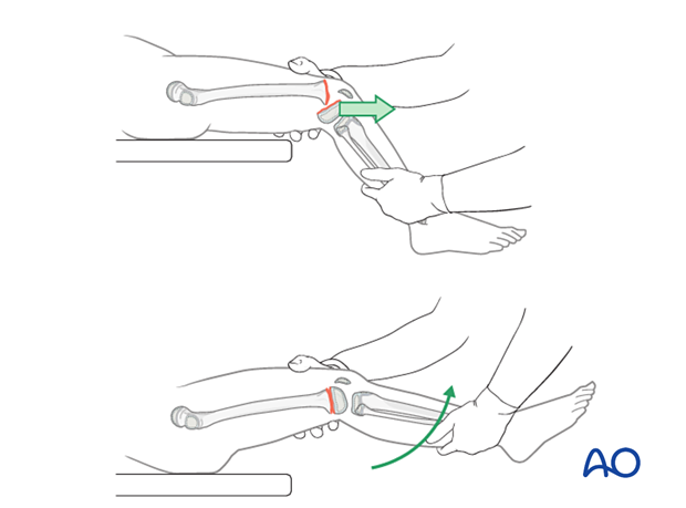 Closed reduction of flexion-type fracture