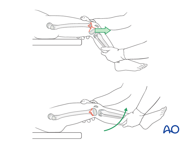 Closed reduction; K-wire fixation followed by casting for ...