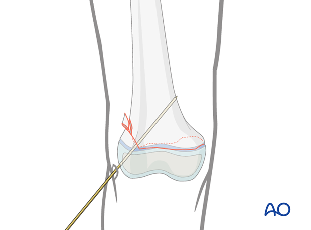 Insertion of first K-wire