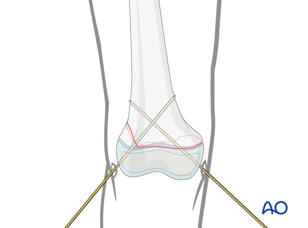 Insertion of second K-wire