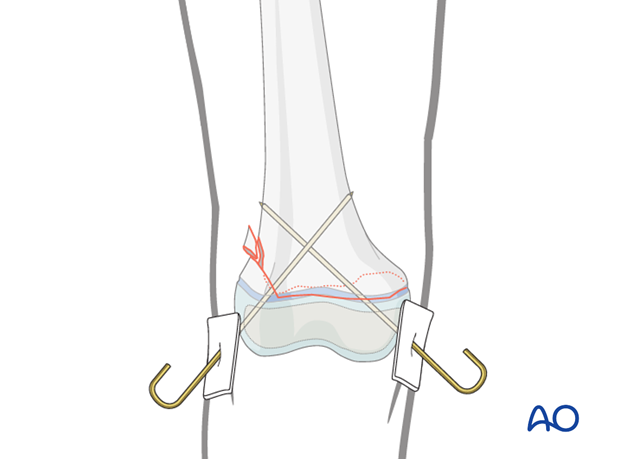 K-wire-wire fixation of distal femoral fracture