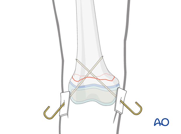 K-wire-wire fixation of distal femoral fracture