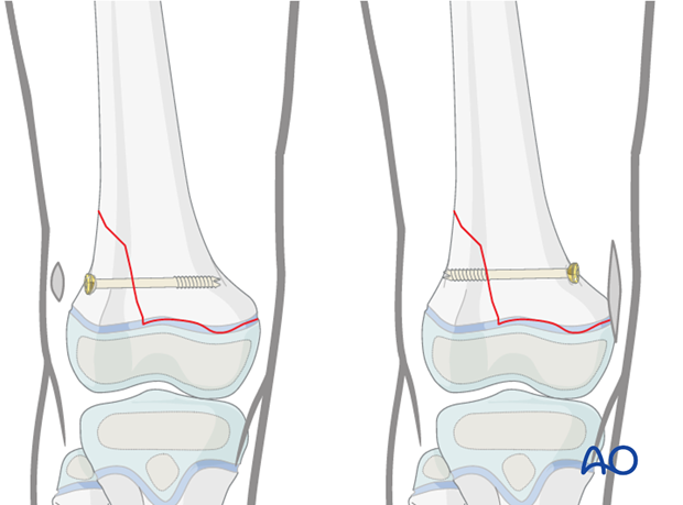 Options for screw fixation of Salter-Harris II fractures