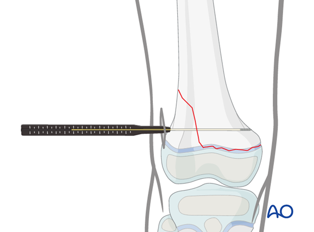 Measuring the appropriate screw length