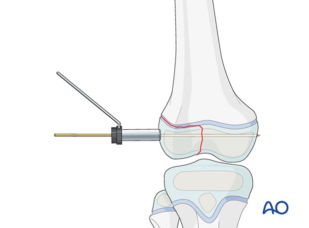 Fixation with K-wire