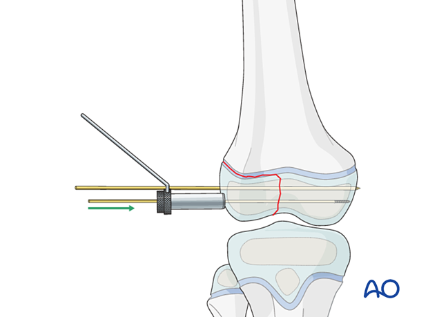 Insertion of guide wire