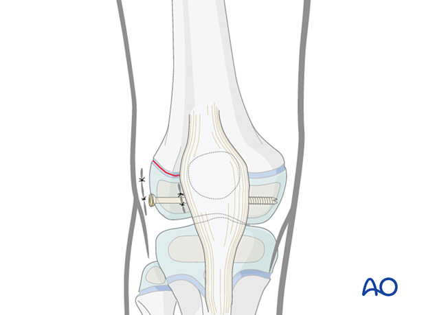 Wound closure