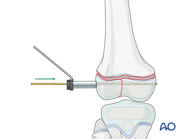 Fixation with K-wires