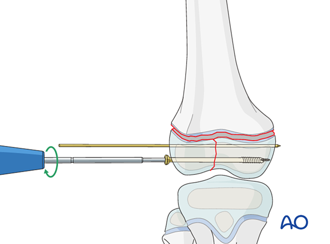 Open reduction; screw and K-wire fixation for Epiphyseal, Salter-Harris ...