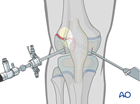 Reduction and screw fixation with arthroscopic assistance