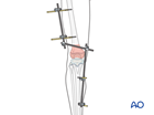 External fixation