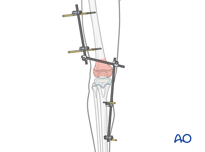 External fixation for Metaphyseal, complete, multifragmentary