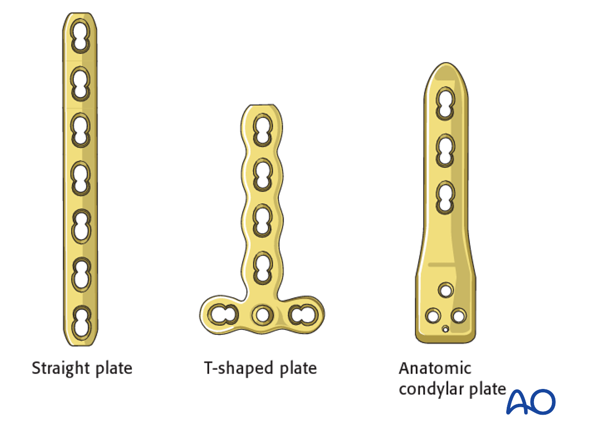 Open Reduction; Plate Fixation For Metaphyseal, Complete, Multifragmentary