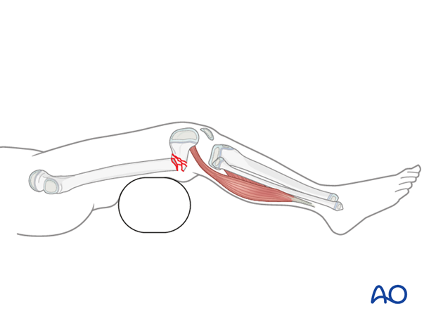 Bolster placed posterior to the fracture